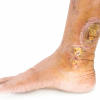 Venous leg Ulcer on ankle